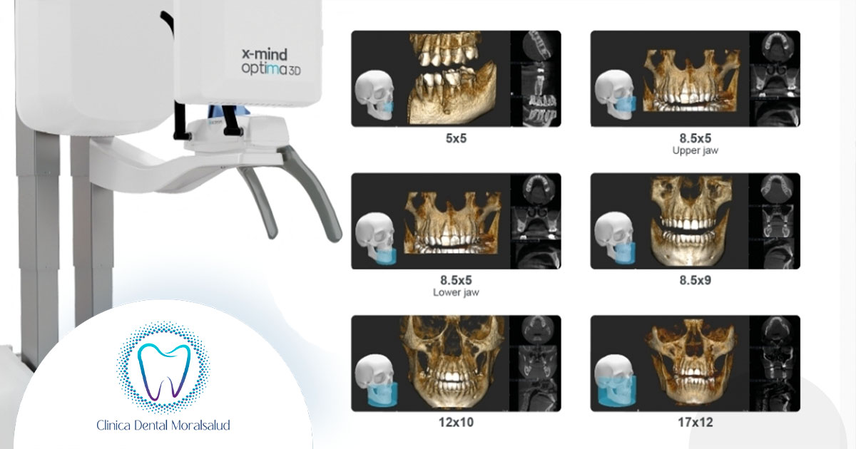 TAC dental (CBCT)